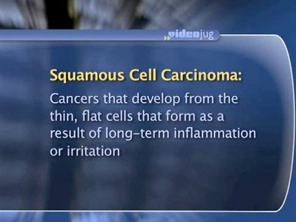 Bladder Cancer Prevention What is the connection between catheters