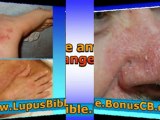Systemic Lupus Erythematosus - Treatment l Reverse Lupus Now