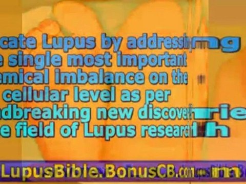 lupus headache - lupus and hair loss - lupus treatment guide