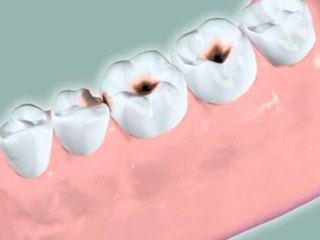 Dentistry Basics : What is a "cavity"?