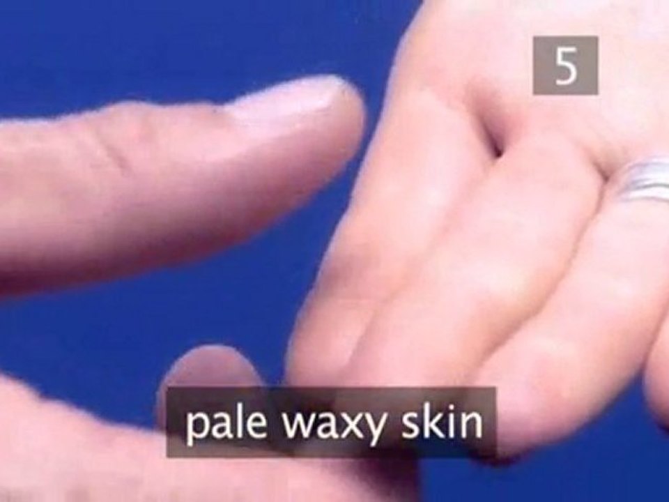 How To Check Circulation After Bandaging