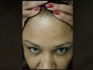 Choose Miami Institute's Botox Miami Treatment