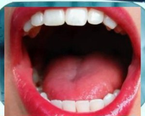 Vancouver BC Dentists Doing Crowns