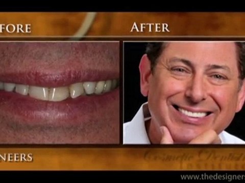 Cosmetic Dentistry Institute - Troy & Detroit–Veneer Patient