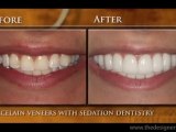 Porcelain Veneers Patient–Troy & Detroit Cosmetic Dentistry
