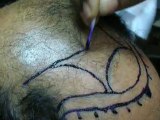 Frontal hairline Marking - hair transplant clinic Pakistan