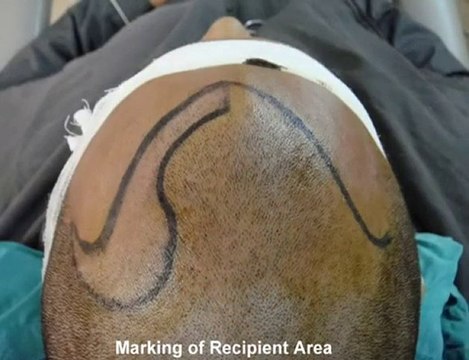 FUE in Pakistan,FUE in Lahore,Hair Transplant Pakistan