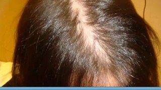 Hair Loss Reviews - Hair Loss Women - Hair Loss Prevention