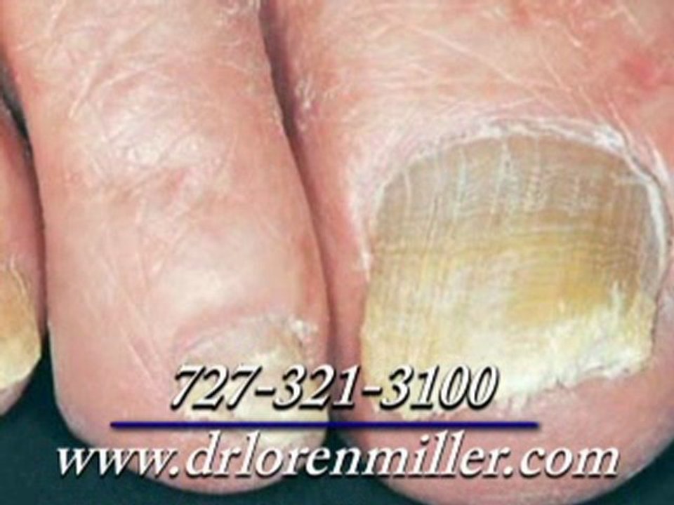 Ingrown Toenails and Fungal Nails - Podiatrist in Clearwater