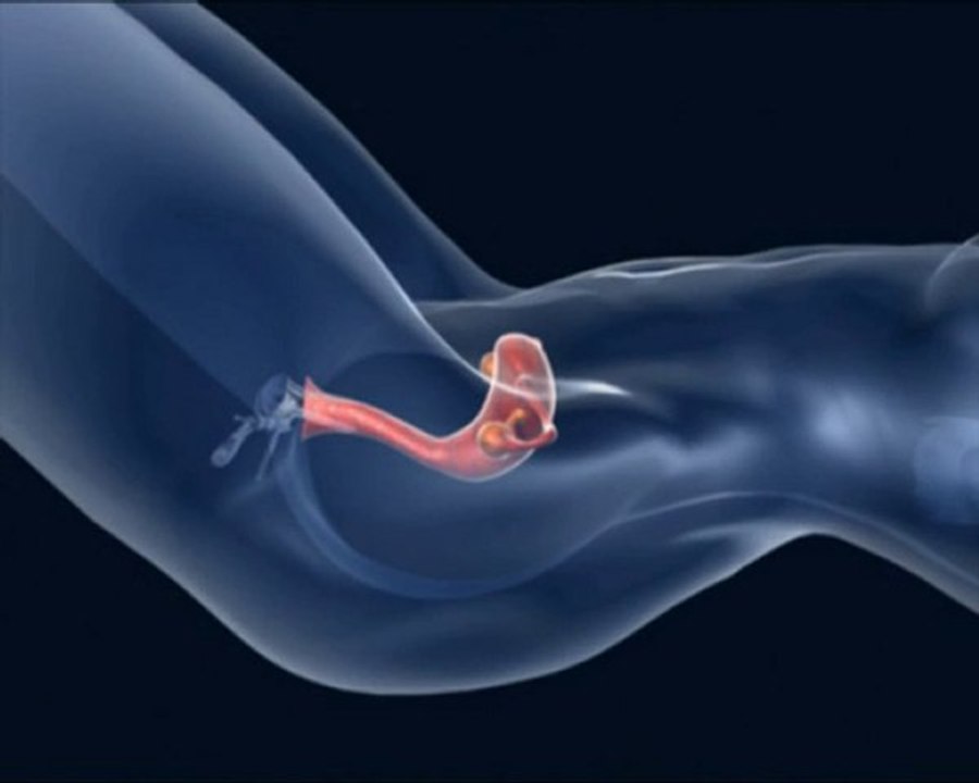 Sperm yıkama ve aşılama