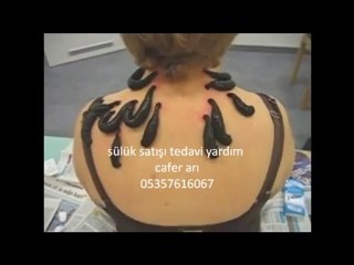 kısaca sülük nasıl vücuda yapıştırılır ,faydaları nedir