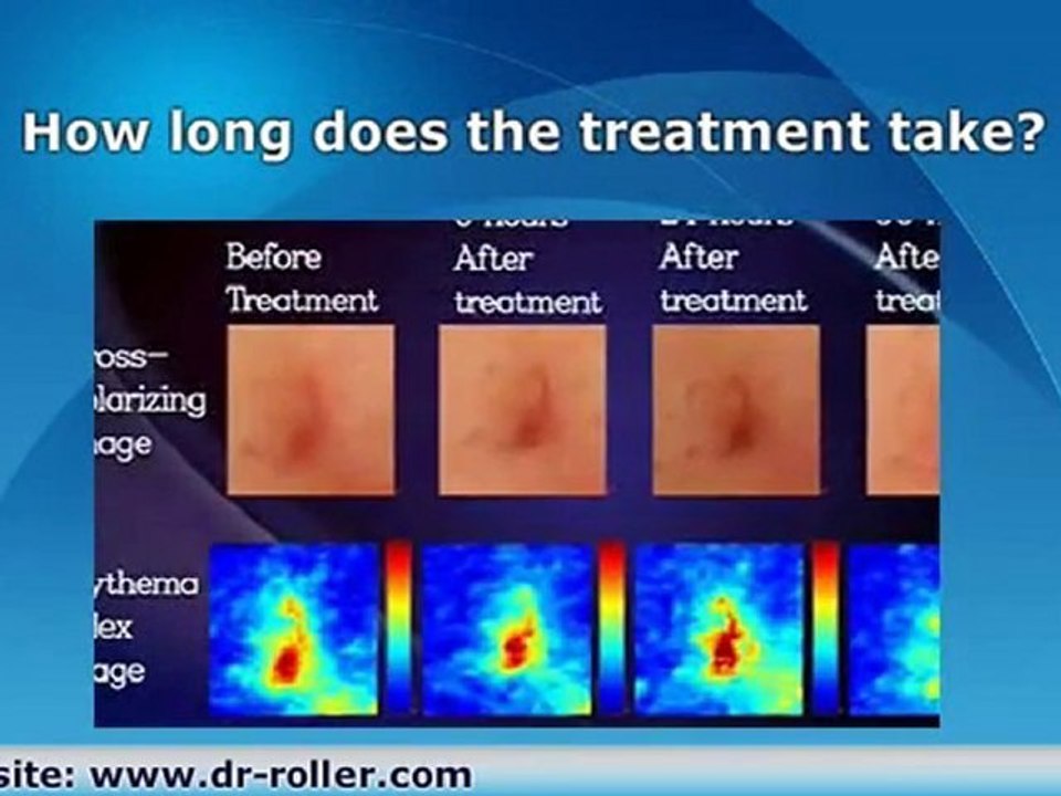 Cleane Acne Therapy Device from Dr Roller