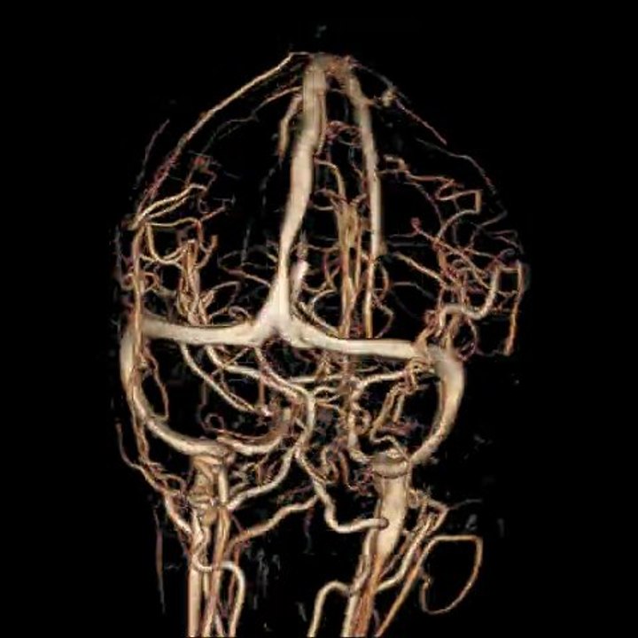 Virtual rendering of the brain's vessels