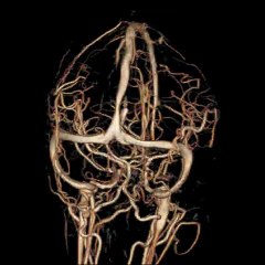 Virtual rendering of the brain's vessels