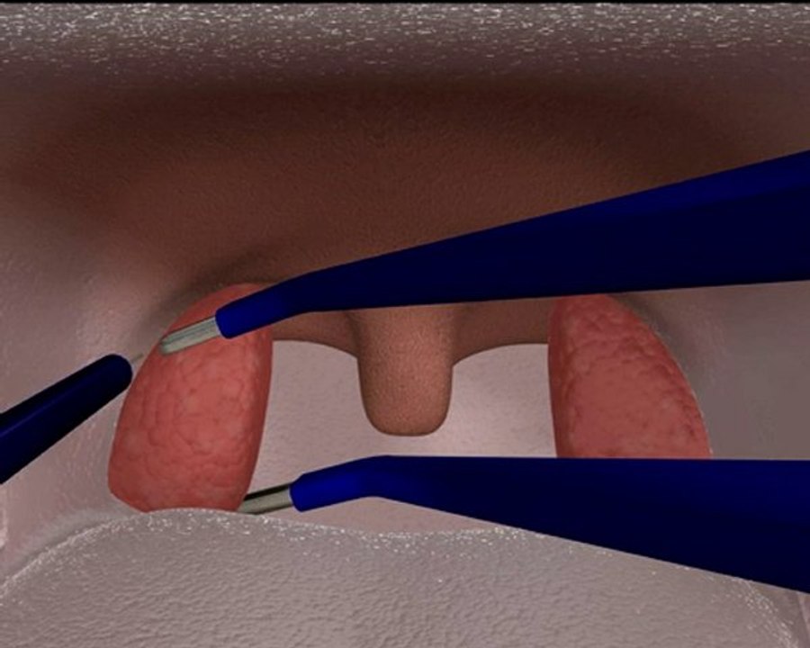 Tonsillotomie ProCut