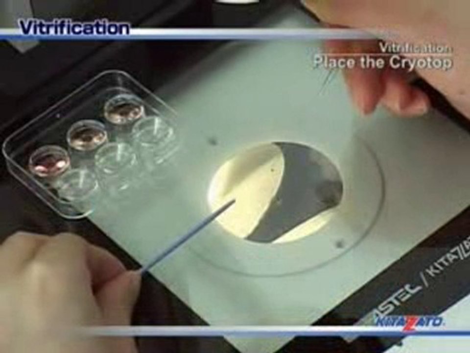 Oocyte Vitrification