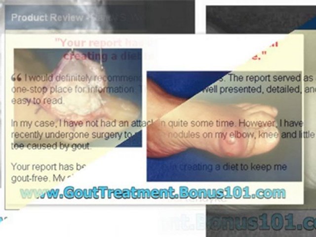 treatment for gout – treatment of gout