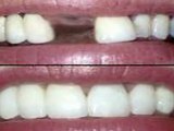 What Can Dental Bridges Do for Me? - Lakeway Cosmetic Denti