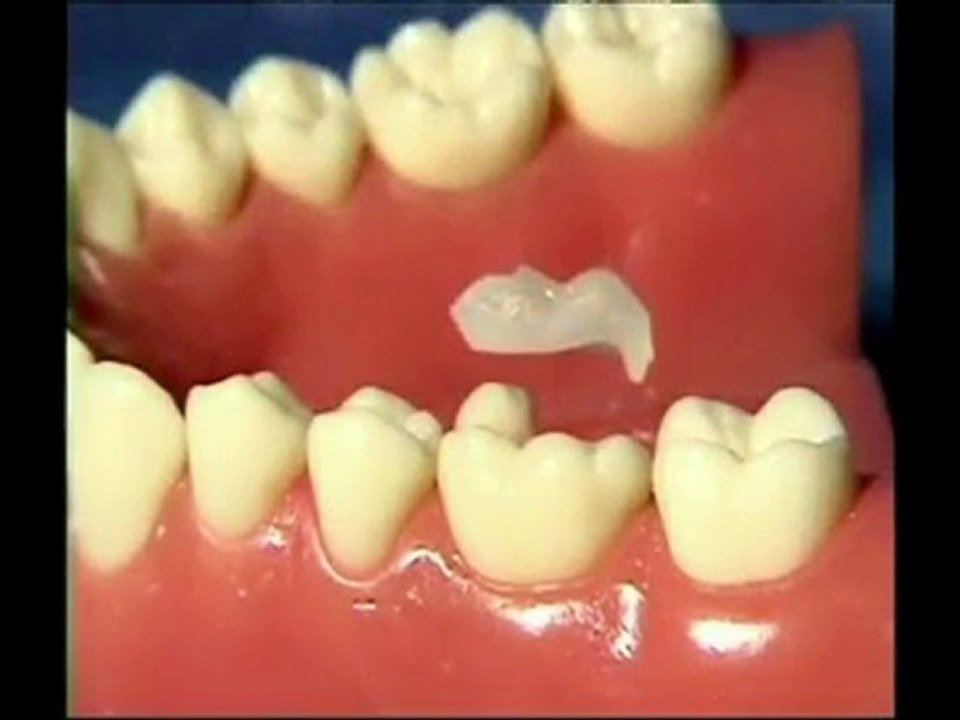 Worried about Tooth Fillings? - Lakeway Cosmetic Dentistry