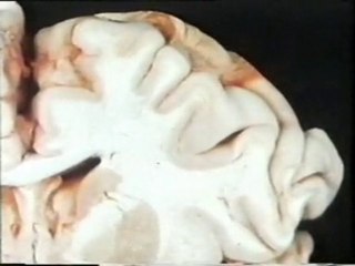 Cerebro: Sustancia blanca y gris