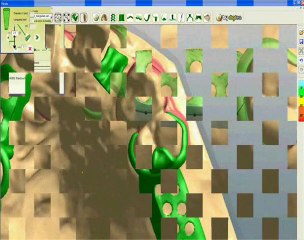 DIGISTELL - CAO pour prothèses adjointes