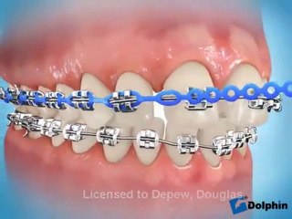 Elastomeric Chain Closing Spaces in Teeth
