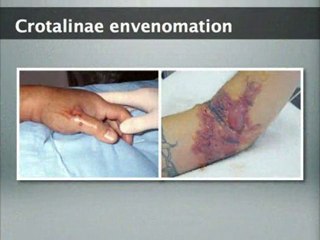 Seriously: Alcohol and Rattlesnakes Don't Mix