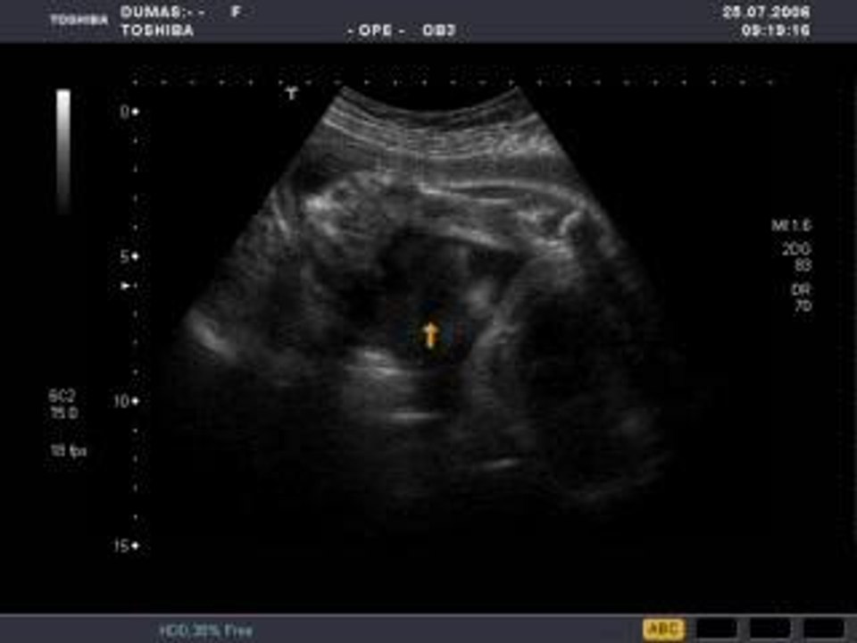 nez et bouche avec main sur le visage