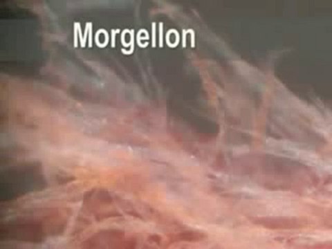 Interview Hildegarde staninger Morgellons, chemtrails 1sur7