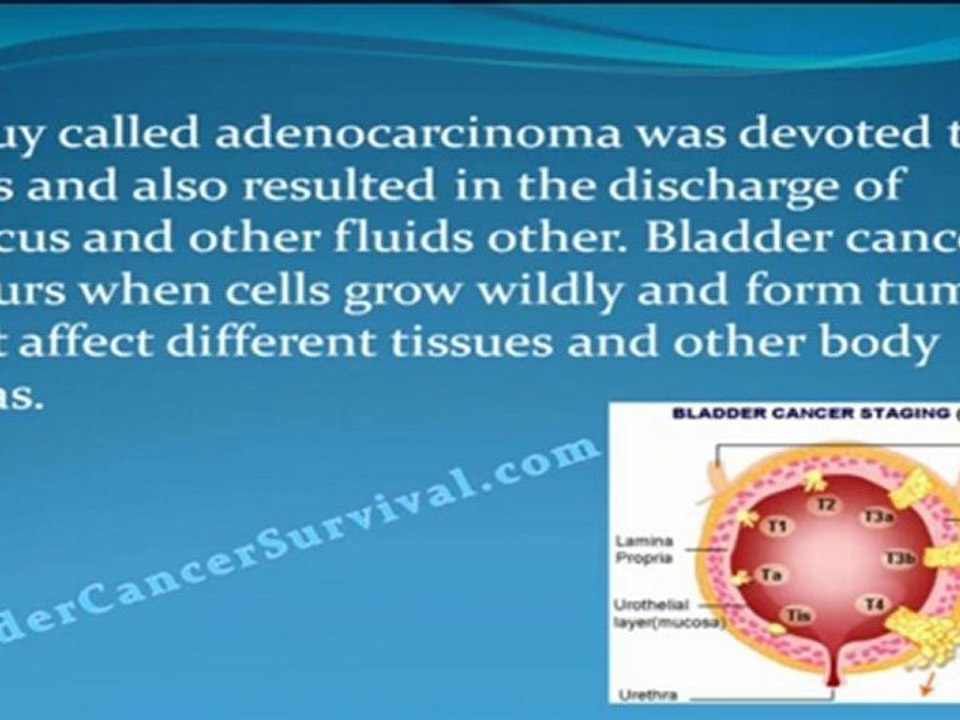 Bladder Cancer Survival