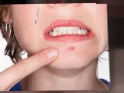 Como Eliminar El Acne y Espinillas Facilmente
