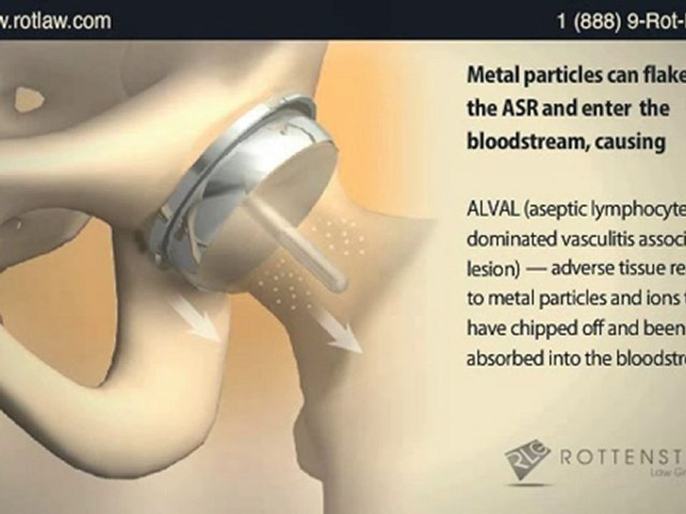 DePuy ASR Hip Replacement Lawsuit Settlement