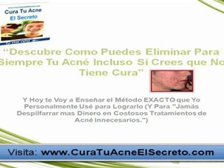 Cura Para el Acne (Los 2 Pasos para eliminarlo)