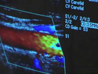 Cardiac (Carotid) Ultrasound | Life Line Screening