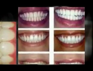 Dentist Scottsdale cosmetic veneers