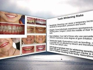 Understanding Tooth Discoloration & Solutions