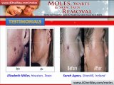 Get Rid Moles On Skin | Moles And Warts