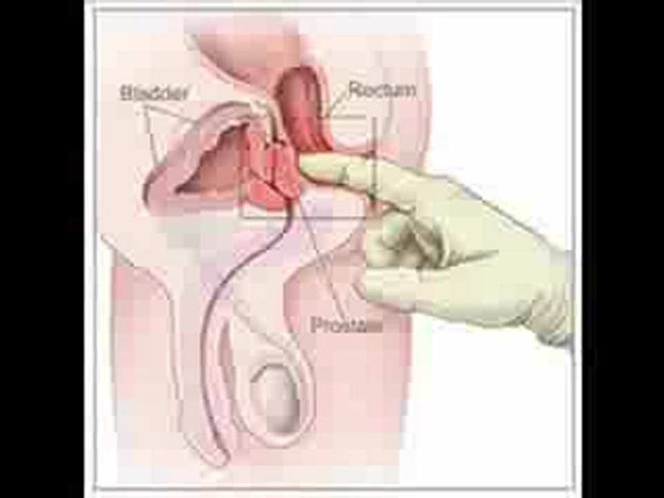 prostate forte