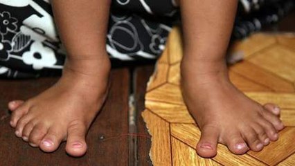 Une fillette avec 14 orteils !