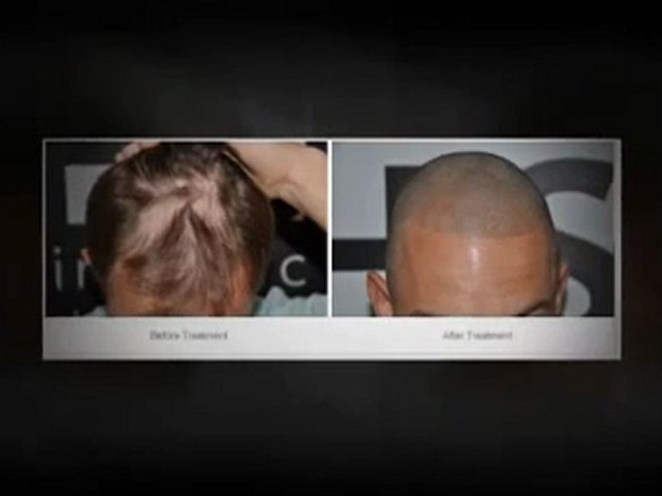 Hair Transplant UK