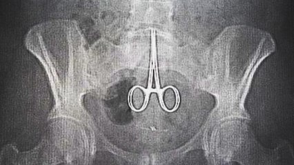 Elle vit 6 mois, des ciseaux dans le ventre !