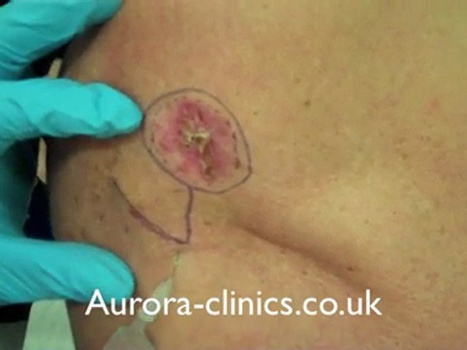 BCC- Basal cell carcinoma removal and local flap