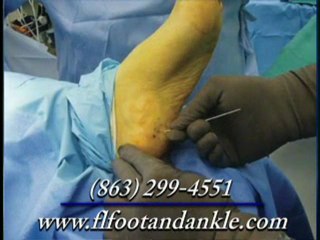 Heel Pain Treatment - Winter Haven Podiatrist