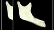 Dental Implants Bone Atrophy - Lower Mandible