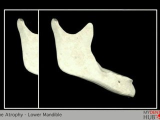 Dental Implants Bone Atrophy - Lower Mandible