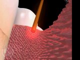 Laser Periodontal Gum Disease Treatment - Bronx, New York