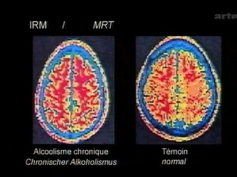 Drogues et cerveau - Le Tabac et l'Alcool - 2-3