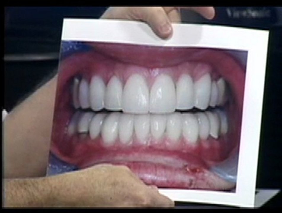 Odessa Porcelain Dental Veneers under Sedation - Robin Ruthe