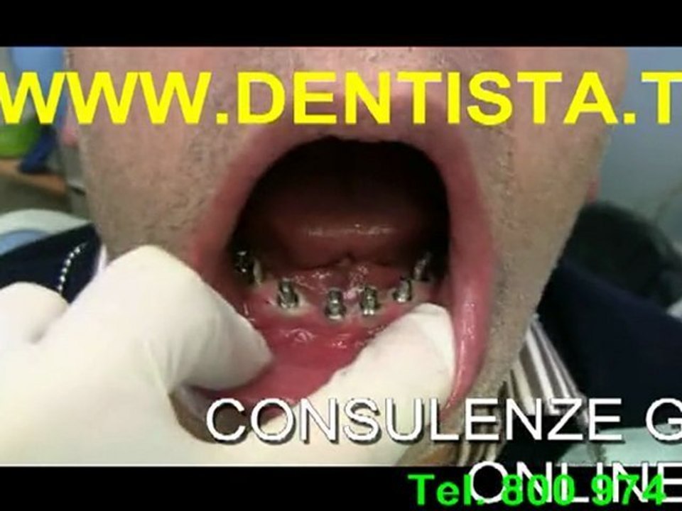 IMPLANTOLOGIA DENTI FISSI IN UN GIORNO