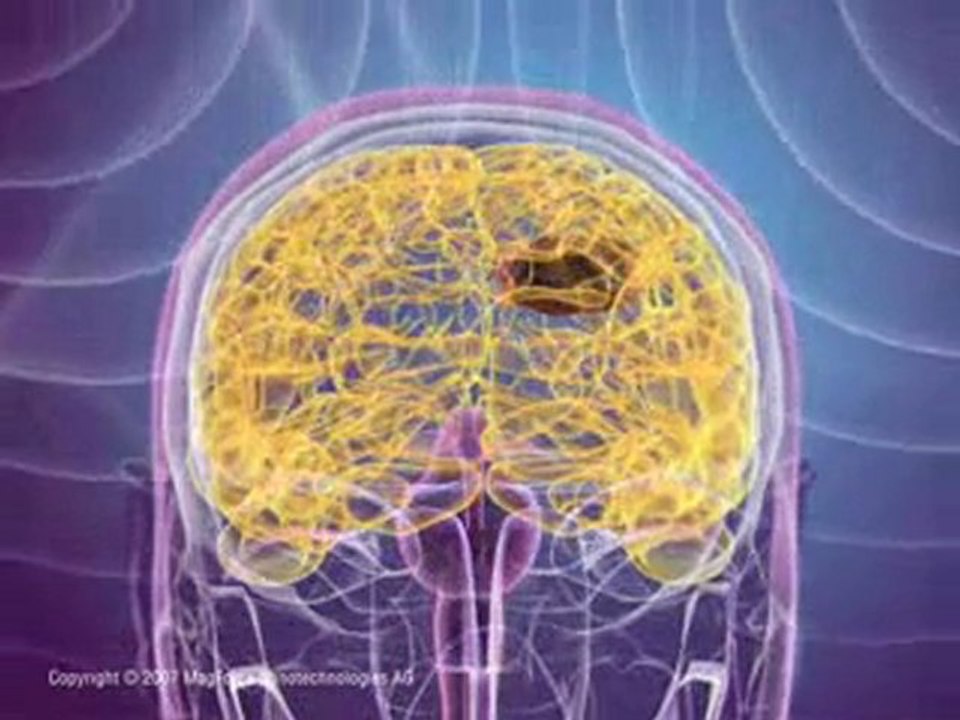 Fighting Cancer with Magnetic Nanoparticles